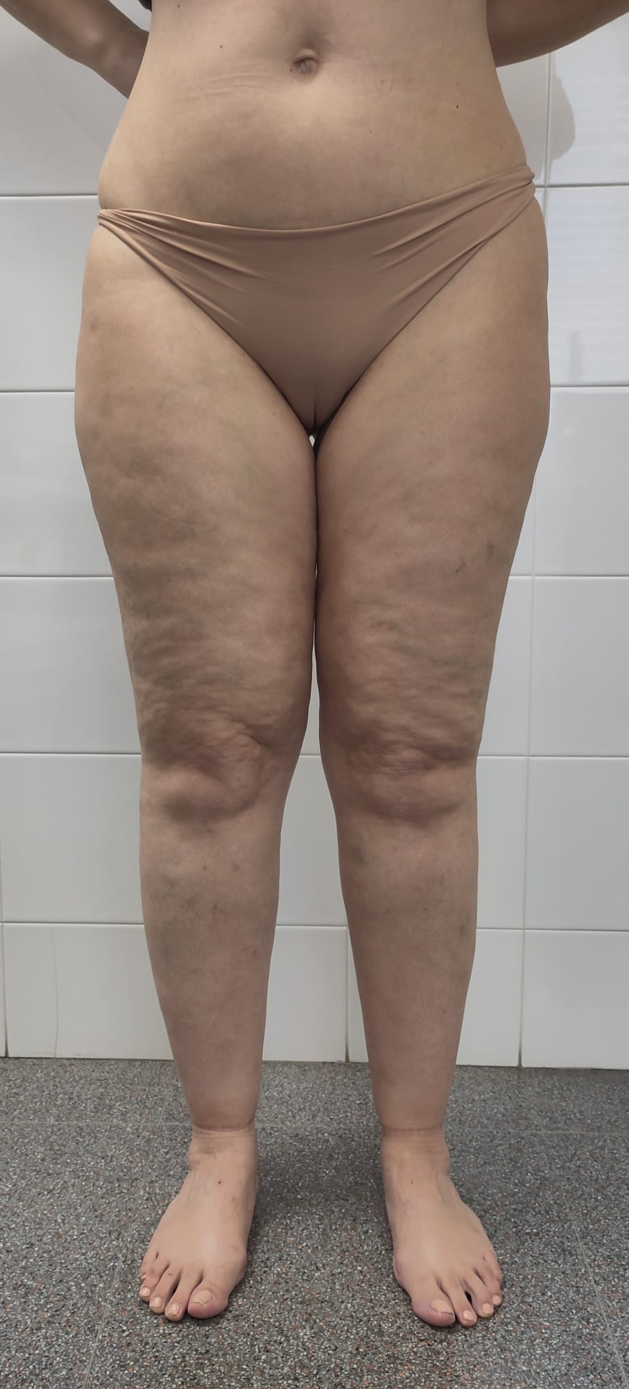 Dells on Legs? Lipedema or Cellulite: Symptoms & How to Find Help